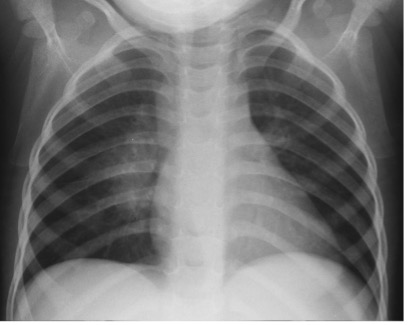 Child CXR